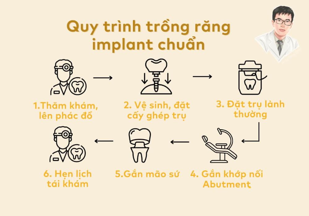 Sơ đồ quy trình trồng răng implant tiêu chuẩn từ thăm khám đến hoàn thiện mão sứ, theo đúng kỹ thuật an toàn quốc tế.