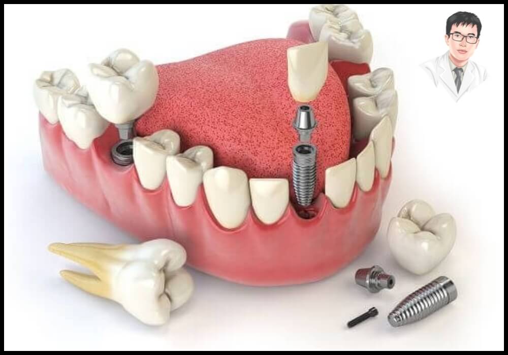  Hình ảnh minh họa quy trình đặt trụ implant vào xương hàm trong điều trị mất răng.