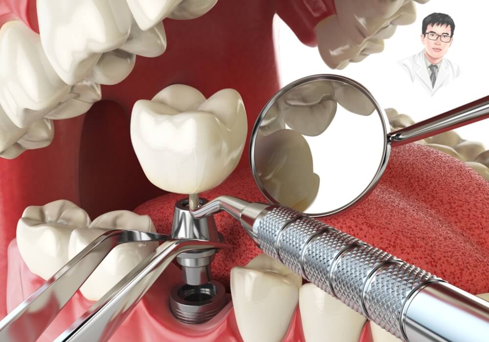 Quy trình trồng răng Implant diễn ra như thế nào? Xem ngay hình ảnh thực tế từ phòng khám! Hình ảnh mô tả chi tiết quy trình nha sĩ gắn trụ implant vào xương hàm trong phòng khám nha khoa.