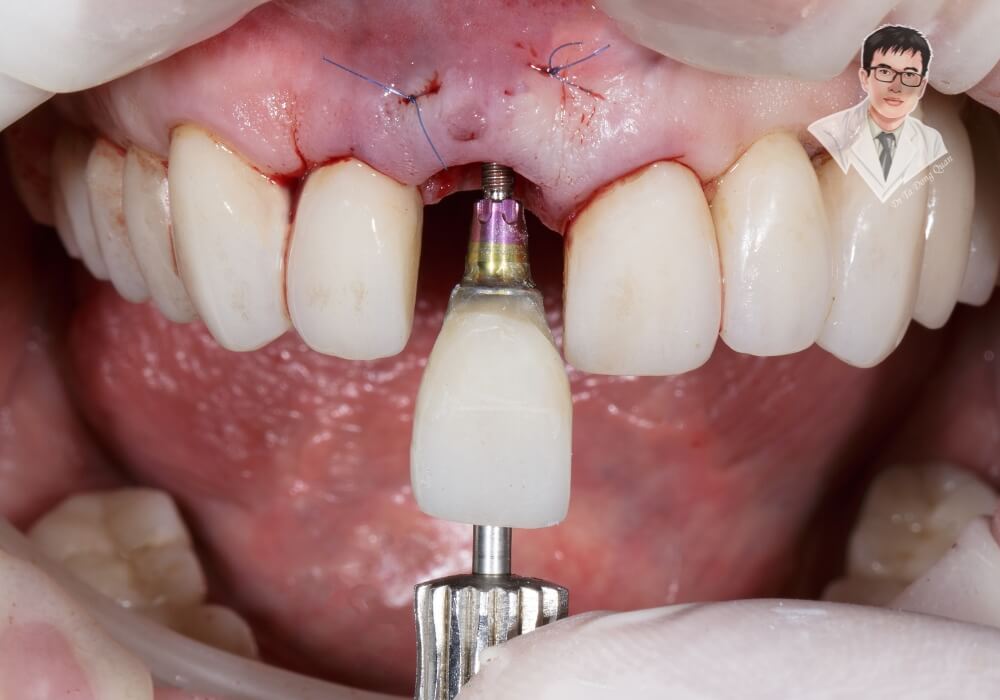 Hình ảnh cận cảnh quá trình phục hình răng Implant thực tế trên bệnh nhân, thể hiện rõ trụ và mão sứ được lắp đặt.