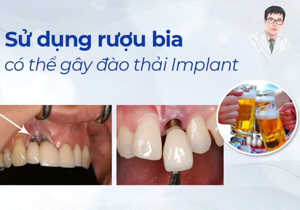 Rượu bia – Kẻ thù thầm lặng khiến implant không tích hợp, bạn có biết? Uống rượu bia sau khi cấy ghép implant có thể cản trở quá trình lành thương và dẫn đến đào thải trụ răng.