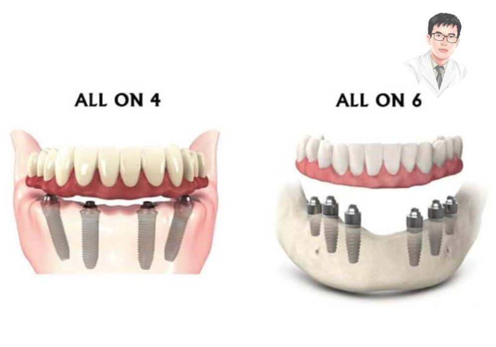 Minh họa kỹ thuật trồng răng implant toàn hàm theo phương pháp All-on-4 và All-on-6 với số lượng trụ implant khác nhau.