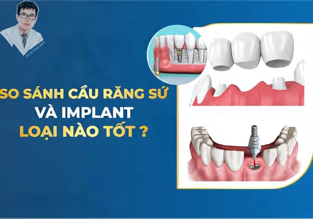 Hình ảnh so sánh giữa cầu răng sứ và implant, giúp người bệnh lựa chọn phương pháp phục hình răng phù hợp.
