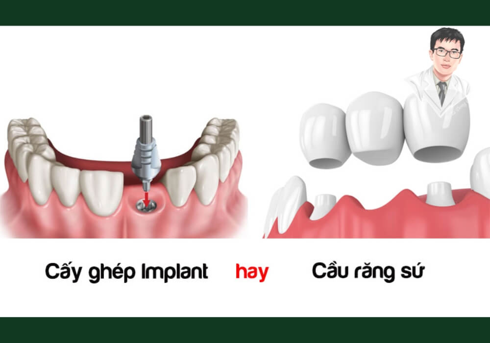 Hình so sánh trực quan giữa implant và cầu răng sứ, giúp bệnh nhân lựa chọn giải pháp phù hợp nhất khi mất răng.