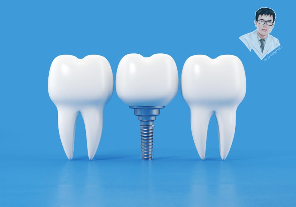 Răng Implant có khác gì răng thật? Khám phá ngay trước khi xem bảng giá trồng răng Implant mới nhất. Hình ảnh so sánh răng thật và răng Implant trên nền xanh, làm nổi bật thiết kế trụ và mão sứ mô phỏng răng tự nhiên.