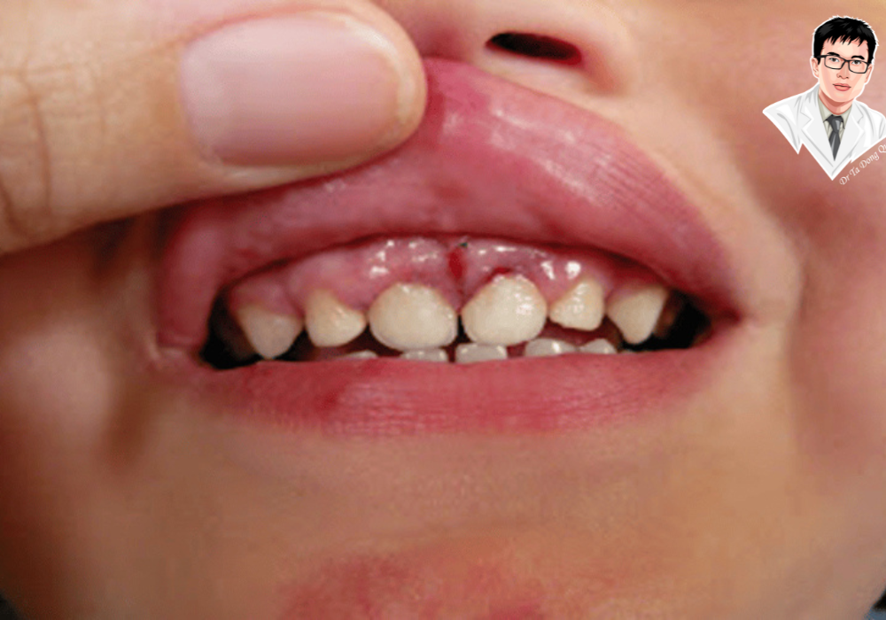 Dấu hiệu sưng lợi do viêm nướu ở trẻ