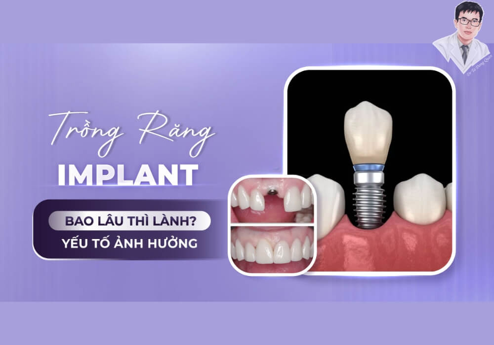 Hình ảnh tổng hợp chủ đề "Trồng răng Implant bao lâu thì lành?" với thông tin trực quan và yếu tố ảnh hưởng chính.