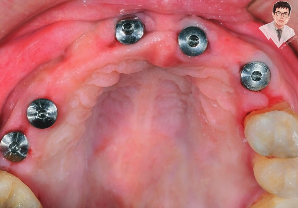 Hình ảnh minh họa quá trình cấy ghép nhiều trụ implant vào xương hàm phục hồi răng đã mất.