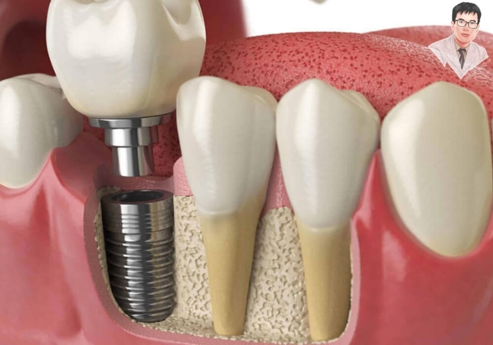 Mô phỏng quy trình cấy ghép implant đơn lẻ vào xương hàm và gắn mão răng sứ.