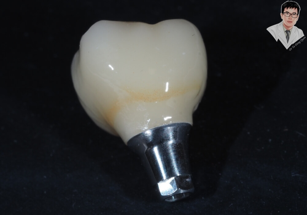 Hình ảnh răng implant hoàn chỉnh với trụ và mão răng sứ tự nhiên sau khi phục hình.