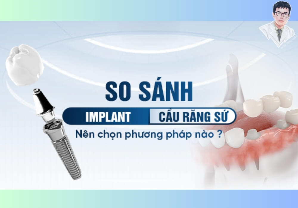 So sánh ưu nhược điểm giữa cấy ghép implant và cầu răng sứ trong phục hình răng mất.