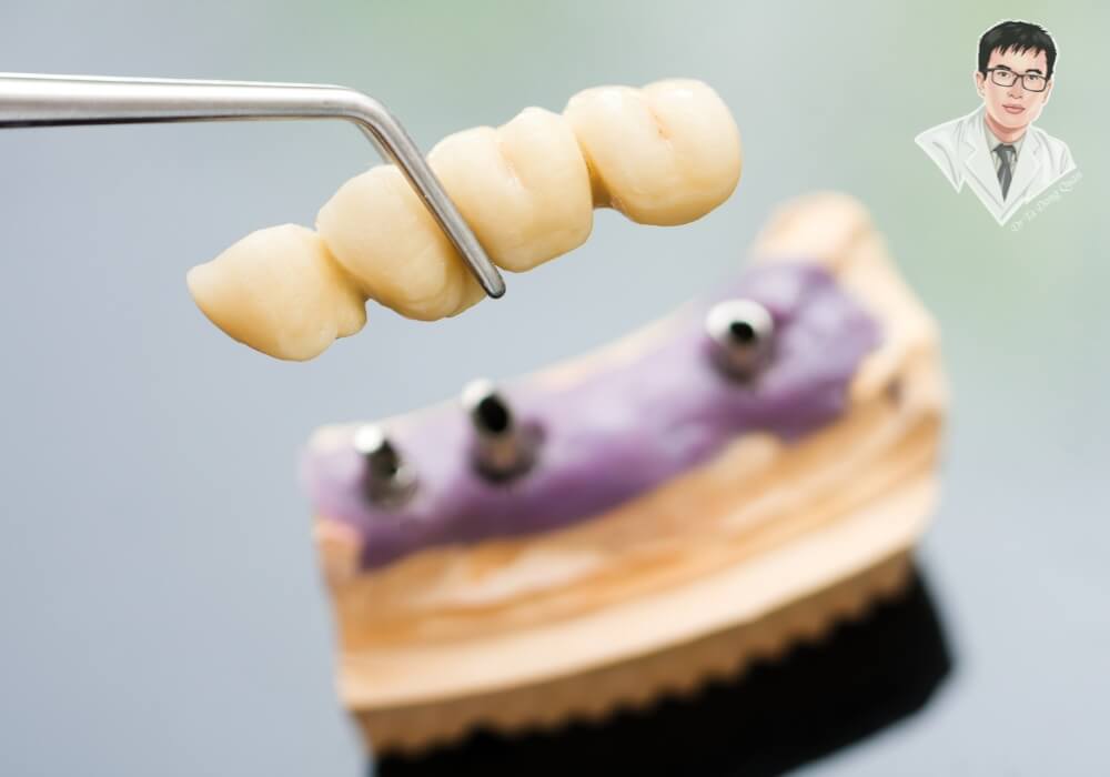 Hình ảnh kỹ thuật viên nha khoa đang gắn mão sứ lên trụ Implant tại vị trí răng cửa, mô phỏng giai đoạn cuối trong quy trình trồng implant phục hình răng thẩm mỹ.