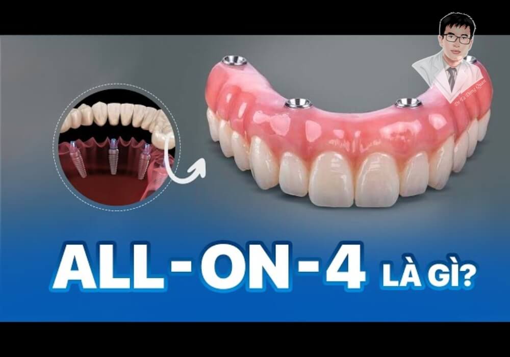 Trồng răng Implant All On 4 là gì? Tìm hiểu ngay giải pháp tối ưu cho người mất răng toàn hàm! Hình ảnh minh họa khái niệm All On 4 – giải pháp trồng răng toàn hàm bằng 4 trụ Implant, mang lại nụ cười hoàn chỉnh cho người mất răng.