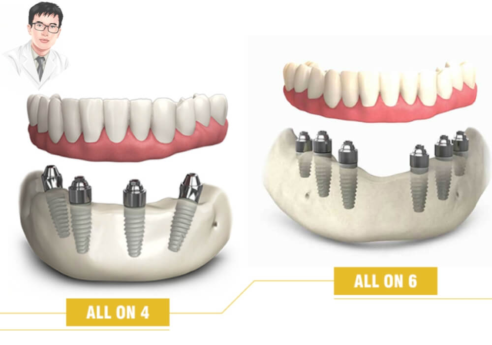 So sánh trực quan giữa hai kỹ thuật trồng răng implant toàn hàm All-on-4 và All-on-6 với vị trí cắm trụ khác nhau.