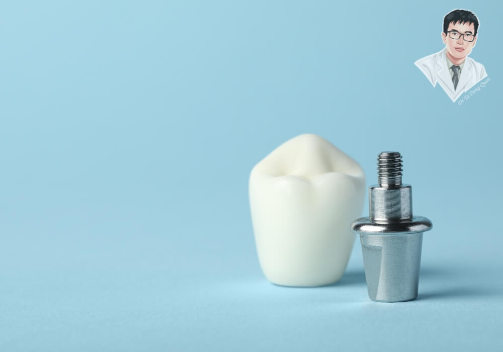 Mô phỏng cấu tạo của trụ và mão sứ trong kỹ thuật trồng răng Implant All On 6, với màu sắc rõ nét, đặt trên nền xanh chuyên nghiệp.