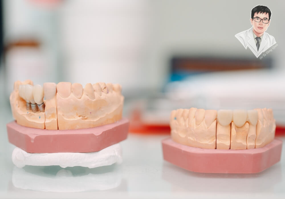 Hình ảnh hai mô hình hàm giả mô phỏng quy trình trồng răng Implant và quá trình lành thương sau phục hình, thể hiện rõ vị trí trụ và răng sứ hoàn chỉnh.