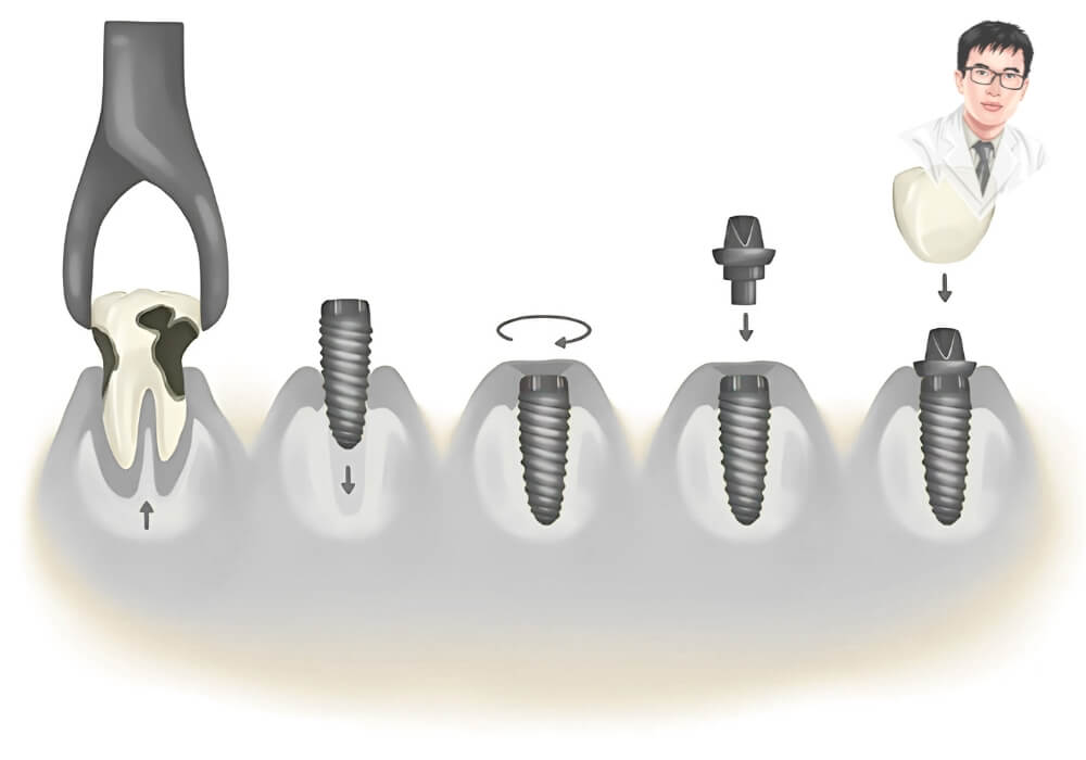 Hình ảnh mô phỏng kỹ thuật nhổ răng trên hàm giả bằng dụng cụ nha khoa, bước đầu cần thực hiện trước khi trồng răng Implant phục hồi răng mất.