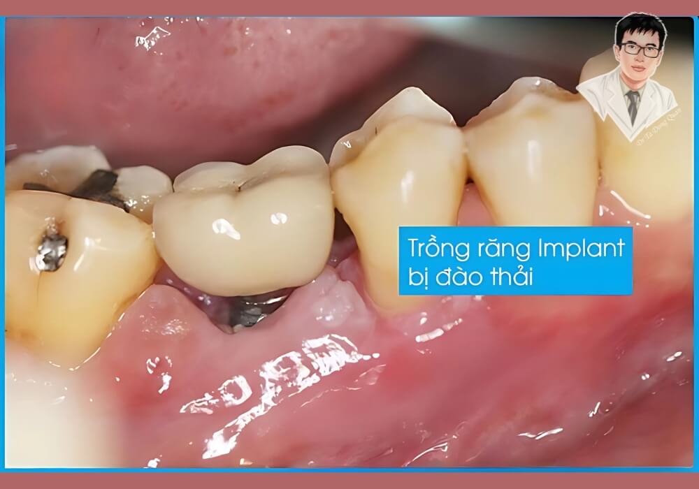 Hình ảnh trụ implant bị đào thải do viêm quanh implant, cho thấy tầm quan trọng của chăm sóc và chẩn đoán chính xác.