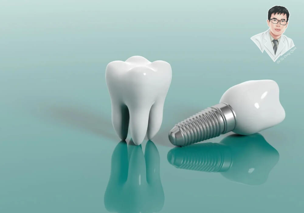 Trồng răng Implant bị đào thải là biến chứng hiếm nhưng nguy hiểm nếu trụ không tích hợp với xương hàm – Phát hiện sớm sẽ giúp khắc phục kịp thời và bảo tồn kết quả điều trị. Hình ảnh trụ Implant và răng sứ bị tách rời, đặt cạnh răng thật mô phỏng, thể hiện khả năng trụ không tích hợp dẫn đến hiện tượng đào thải sau khi trồng Implant.