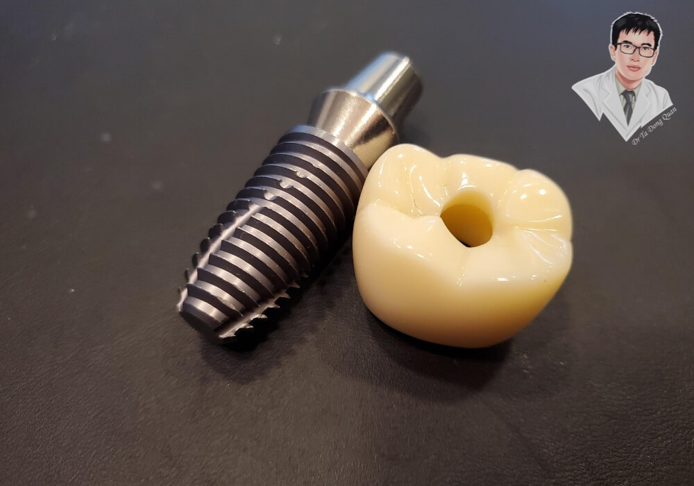 Hình ảnh chi tiết một trụ Implant nha khoa và mão sứ phục hình đặt trên nền đen, minh họa cấu tạo chuẩn y khoa trong kỹ thuật trồng răng hiện đại.
