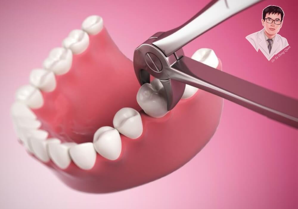 Hình ảnh mô phỏng quá trình nhổ răng bị tổn thương trên cung hàm giả, bước tiền đề quan trọng trước khi tiến hành trồng răng Implant để phục hình răng đã mất.