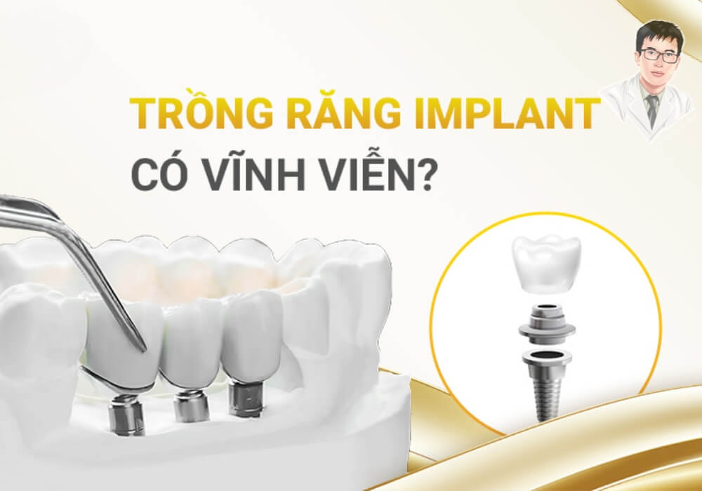 Hình ảnh tổng quan về trồng răng Implant với mô hình mô phỏng trụ và răng sứ, minh họa câu hỏi "Trồng răng Implant có vĩnh viễn không?"