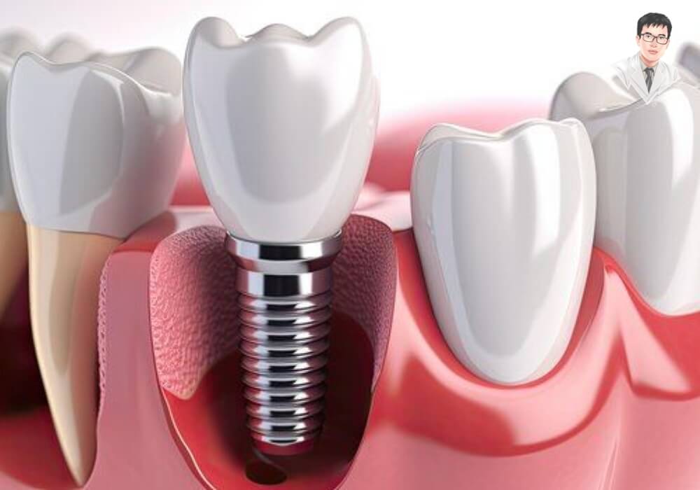 Mô phỏng cấu tạo răng Implant gồm trụ Titanium, Abutment và mão sứ trên nướu – phục hồi răng mất toàn diện.