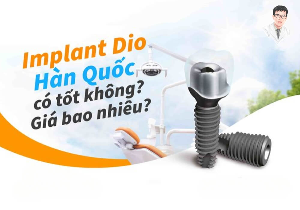 Trụ Implant Hàn Quốc DIO – lựa chọn phổ thông với mức giá hợp lý, phù hợp phục hồi răng mất hiệu quả.