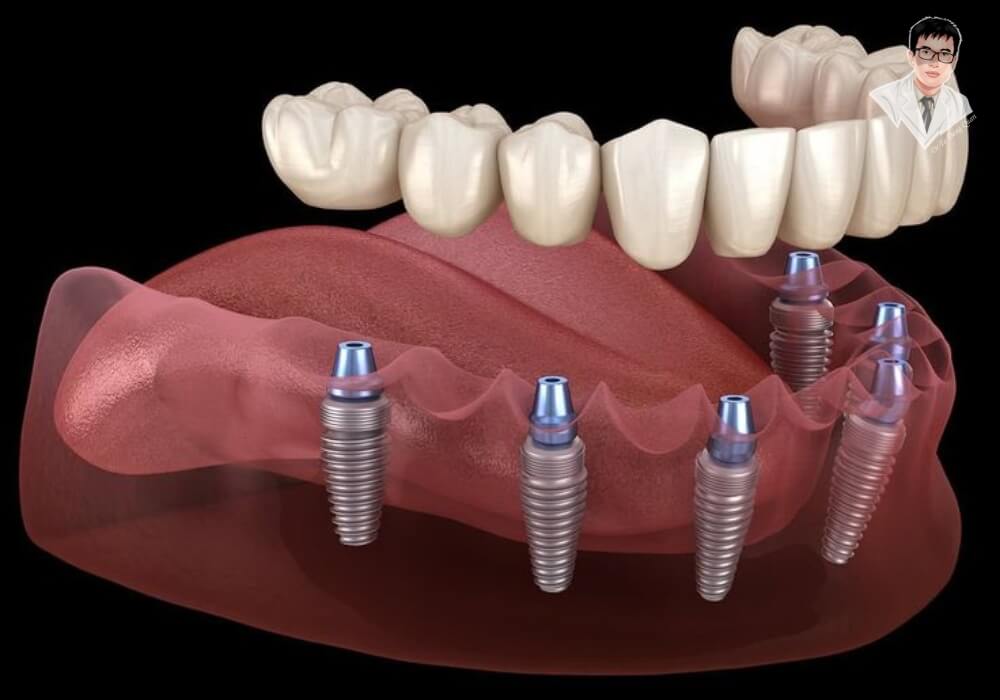 Hình ảnh minh họa trồng nhiều trụ Implant thay thế răng mất toàn hàm, giúp ăn nhai ổn định và lâu dài.
