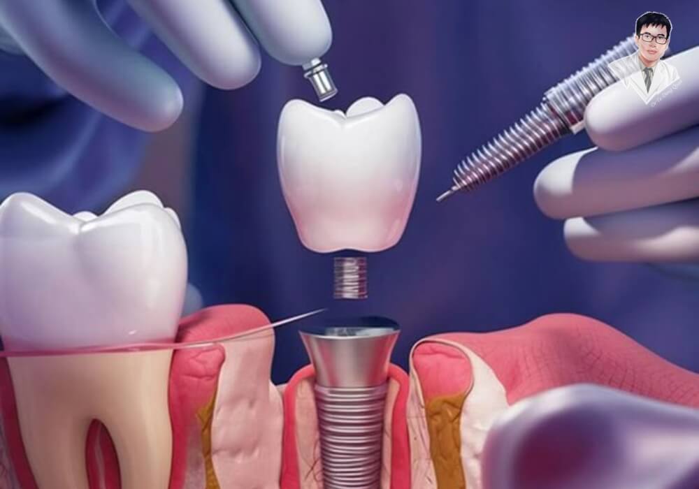 Bác sĩ thực hiện bước cuối cùng trong quá trình cấy ghép Implant – gắn mão sứ lên Abutment cố định.