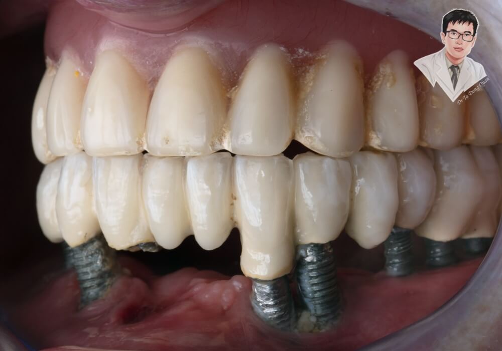 Hình ảnh thực tế quá trình phục hình toàn hàm bằng phương pháp trồng răng Implant với nhiều trụ Implant cố định bên dưới, răng sứ gắn khít bên trên.