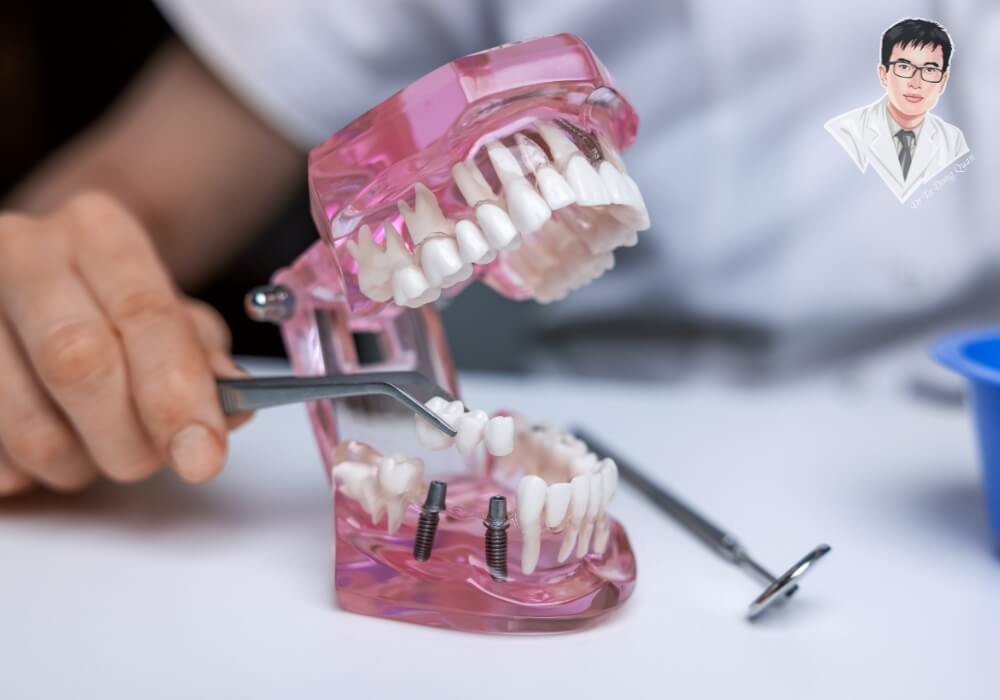 Hình ảnh nha sĩ sử dụng mô hình hàm giả minh họa kỹ thuật trồng răng Implant với trụ Implant được cấy vào hàm dưới, phục vụ tư vấn điều trị và giải thích chi phí.