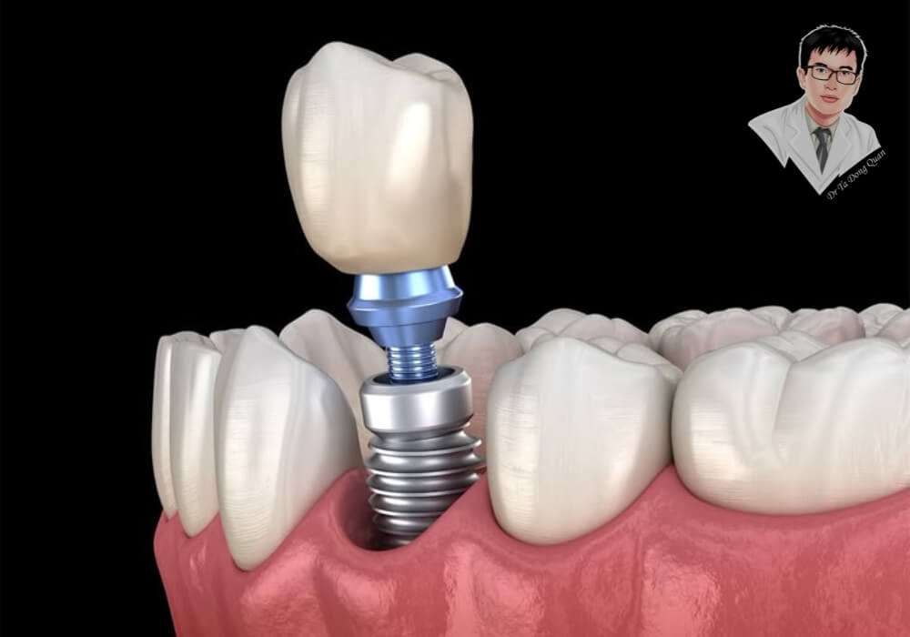 Mô phỏng cấu tạo trụ implant trong xương hàm, bao gồm trụ titanium, abutment và mão sứ gắn bên trên.