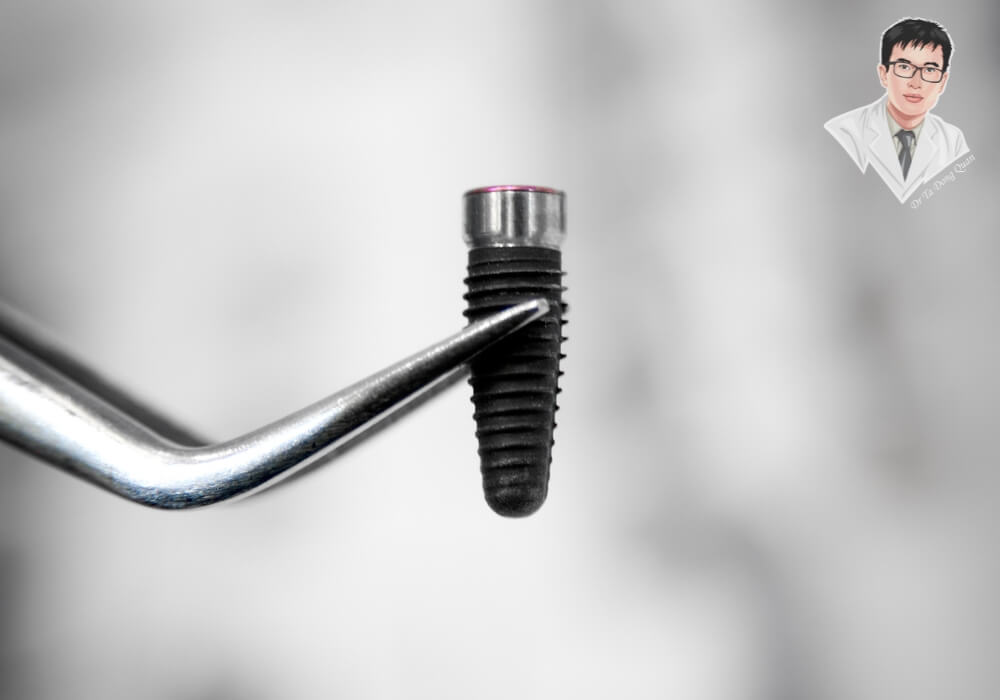 Cận cảnh trụ Implant nha khoa bằng titanium được kẹp bằng dụng cụ y tế, minh họa công nghệ trồng răng Implant hiện đại tại các nha khoa uy tín ở TP.HCM.