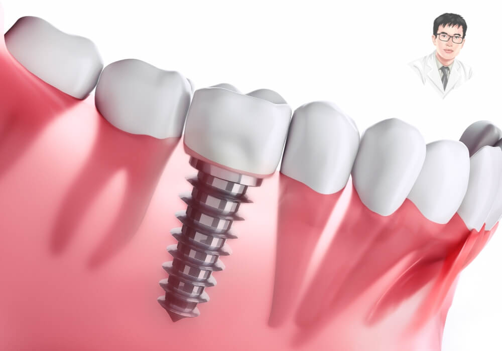 Trồng răng Implant là gì? Cùng khám phá cấu tạo chuẩn y khoa của một chiếc răng implant từ trong ra ngoài! Hình ảnh mô phỏng cấu tạo của răng implant, bao gồm trụ titan cắm vào xương hàm, khớp nối abutment và mão răng sứ phía trên.