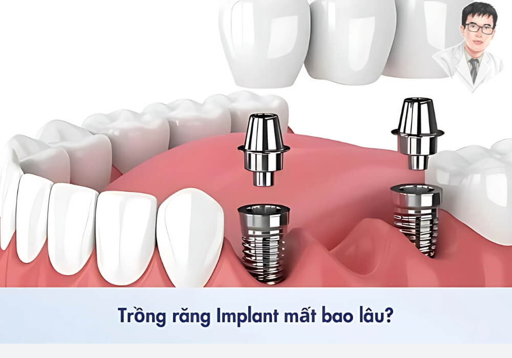 Hình minh họa quy trình cấy ghép Implant và mão sứ trên xương hàm với chú thích hỏi “Trồng răng Implant mất bao lâu?”