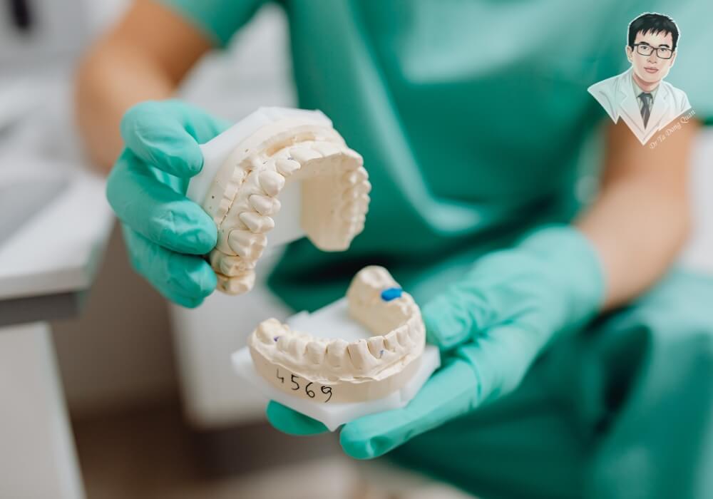 Hình ảnh bác sĩ nha khoa cầm mô hình hàm răng đang tư vấn kỹ thuật trồng răng Implant, minh họa chi tiết vị trí và phương pháp phục hình răng mất.