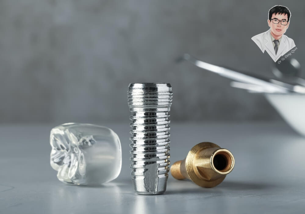 Hình ảnh minh họa ba thành phần cơ bản trong kỹ thuật trồng răng Implant: mão sứ, trụ Implant titanium và khớp nối Abutment, dùng để giải thích cấu tạo và chi phí liên quan.