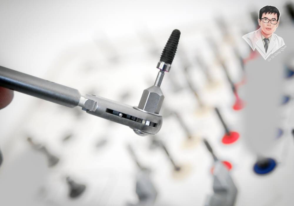 Hình ảnh cận cảnh dụng cụ chuyên dụng dùng để cấy ghép Implant nha khoa, được chuẩn bị trong quy trình trồng răng Implant với kỹ thuật hiện đại.