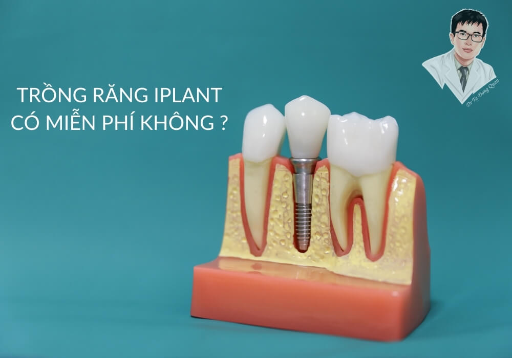 Hình ảnh mô phỏng cấu tạo răng implant kèm câu hỏi “Trồng răng implant có miễn phí không?” giúp mở đầu cho chủ đề.