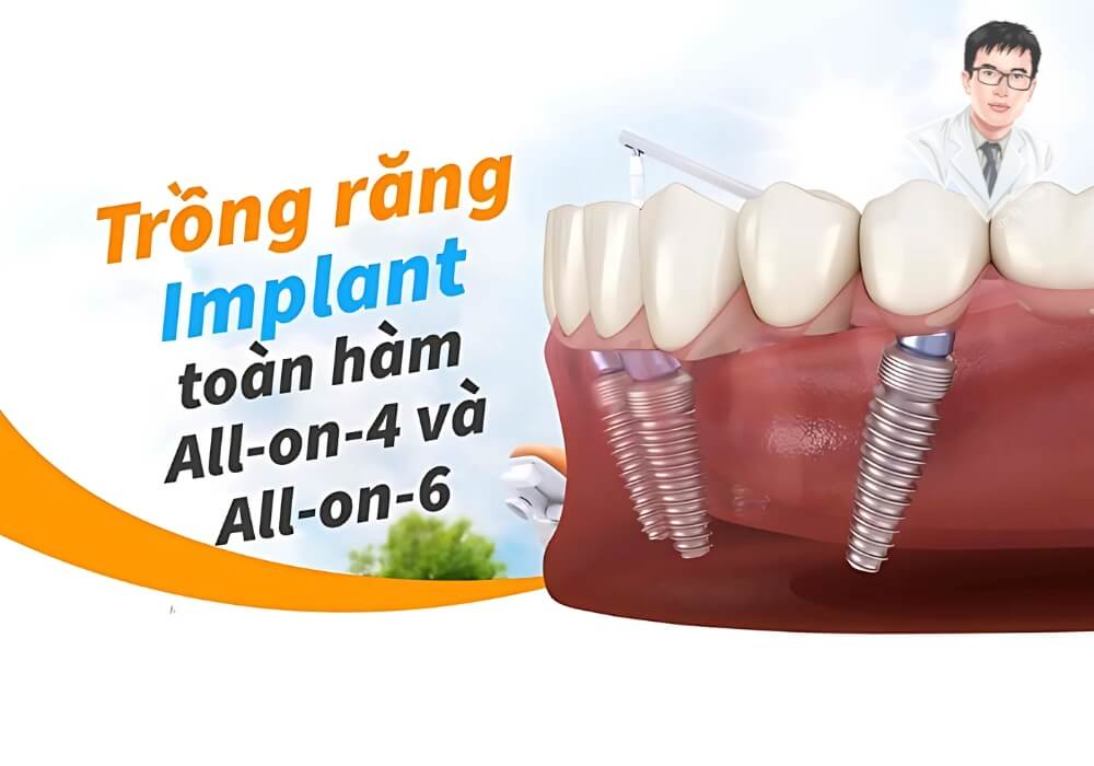 Hình ảnh minh họa tổng quan hai phương pháp All-on-4 và All-on-6 trong điều trị trồng răng Implant toàn hàm.