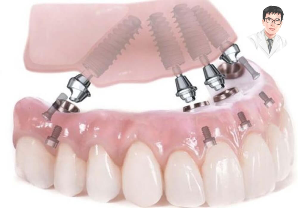Hình ảnh mô phỏng kỹ thuật trồng răng implant toàn hàm All-on-4 với 4 trụ nghiêng hỗ trợ nâng đỡ toàn hàm răng sứ cố định.
