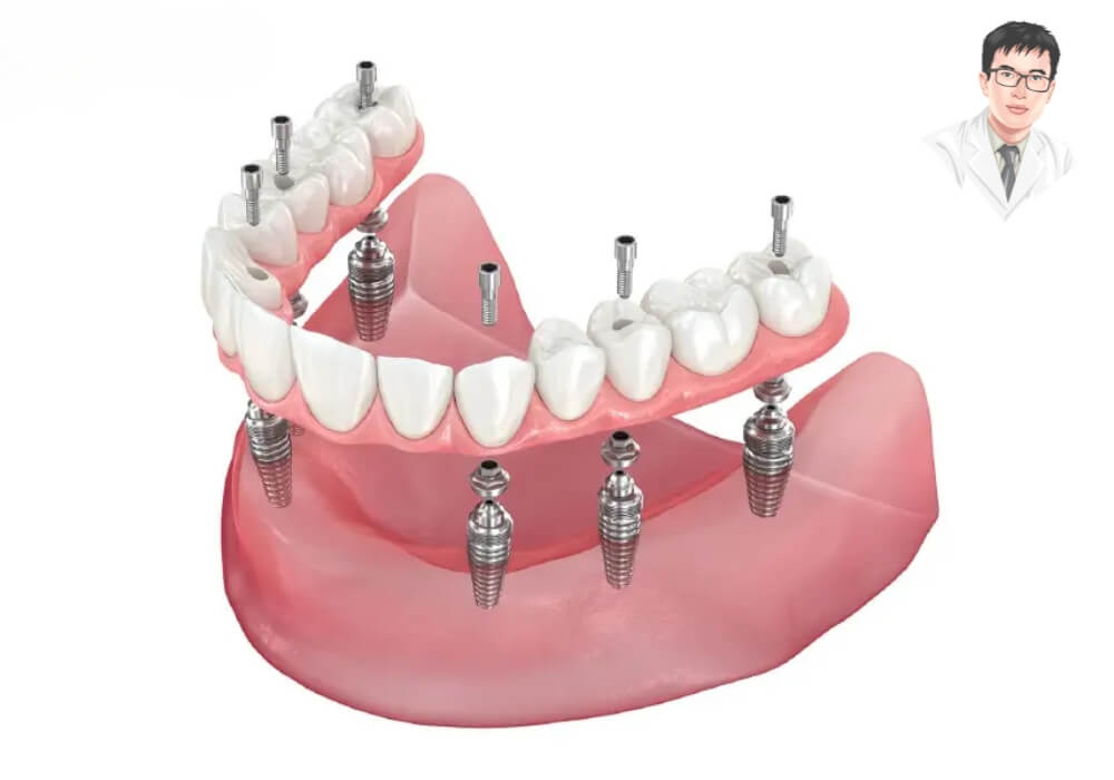 Mô hình 3D thể hiện kỹ thuật All-on-6 với 6 trụ implant hỗ trợ nâng đỡ toàn hàm răng sứ thẩm mỹ.