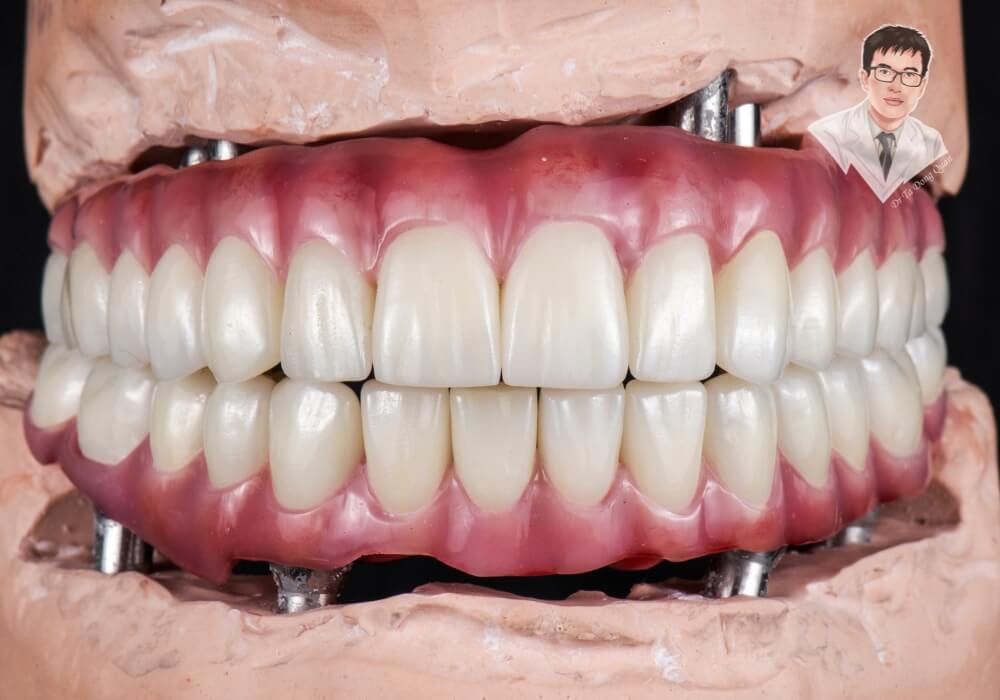 Hình ảnh thực tế mô phỏng hàm implant toàn hàm với cấu trúc răng sứ được gắn cố định lên các trụ titanium trong xương hàm.