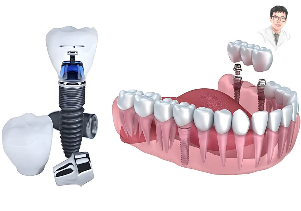 Hình ảnh minh họa trụ Implant titanium và răng sứ được đặt cạnh răng thật mô phỏng, làm nổi bật cấu tạo cơ bản của hệ thống phục hình trong kỹ thuật trồng răng Implant toàn hàm.