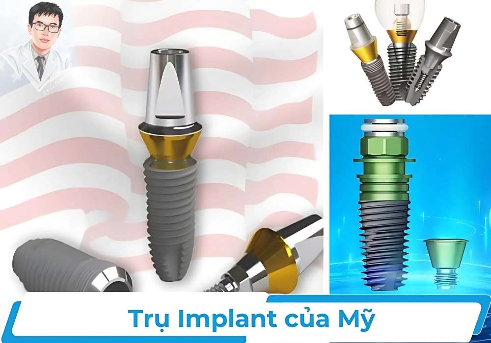 Hình ảnh trụ Implant cao cấp từ Mỹ được sử dụng trong kỹ thuật All On 6, minh họa các bộ phận cấu thành của trụ.