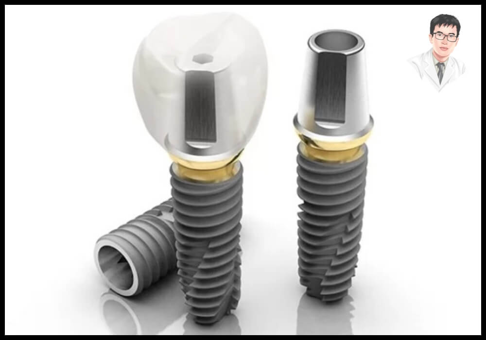Trụ implant kết hợp mão sứ tạo thành chiếc răng hoàn chỉnh, chắc chắn và thẩm mỹ cao.