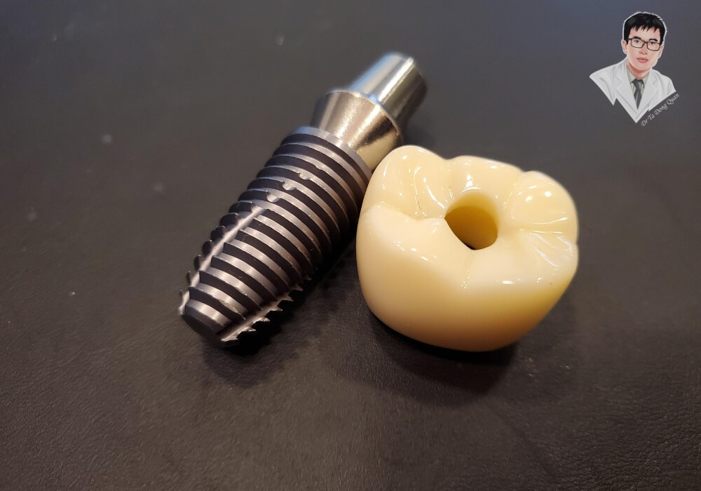 Trụ implant titan kết hợp mão răng sứ trên nền đen, mô phỏng thực tế cho quy trình cấy ghép răng hiện đại và thẩm mỹ.