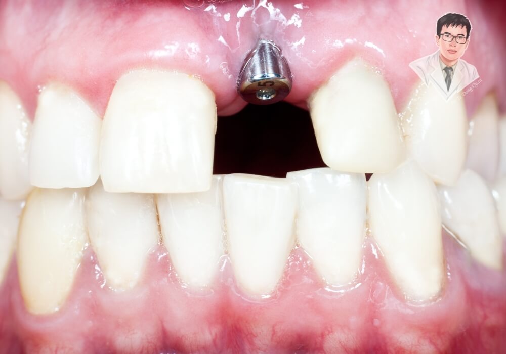  Hình ảnh thực tế trụ implant sau khi cấy ghép trong khoang miệng.