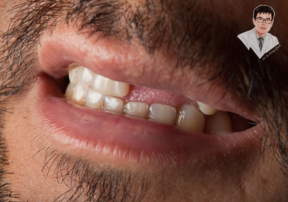 Hình ảnh thực tế bệnh nhân nam bị mất răng cửa trước khi trồng implant.